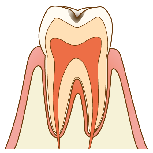 C1：エナメル質まで進行した虫歯