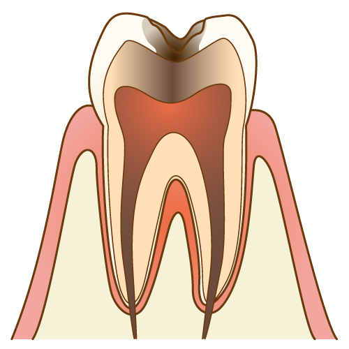 C2：象牙質まで進行した虫歯