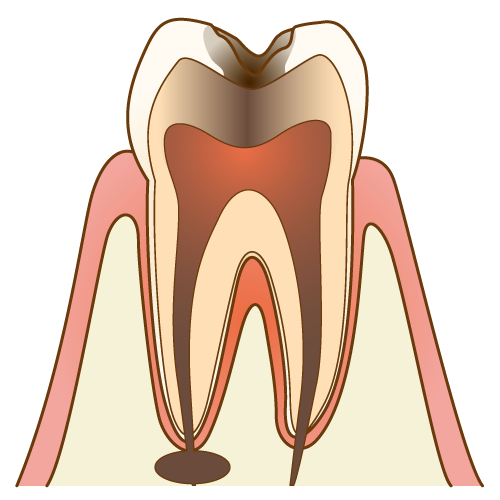C3：歯髄にまで進行した虫歯
